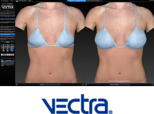 Vectra for Breast Augmentation