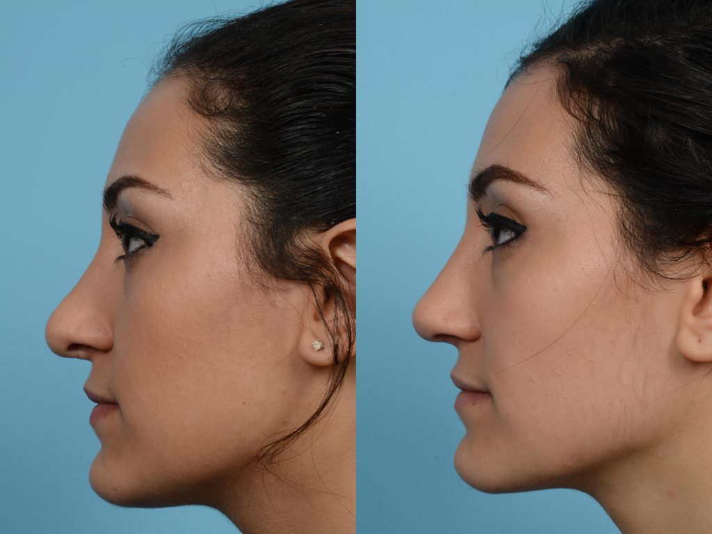 Profile view of woman's nose before and after revision rhinoplasty surgery.