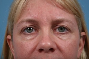 facial fat transfer 5