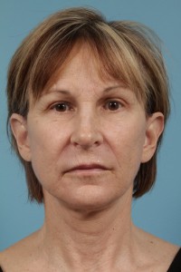 facial fat transfer 6-2