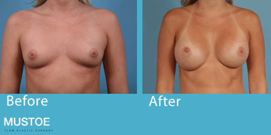 See before-and-after images of breast augmentation patients in Chicago.