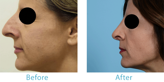 See real patient before-and-after images from Dr. Thomas A. Mustoe, a rhinoplasty surgeon in Chicago.