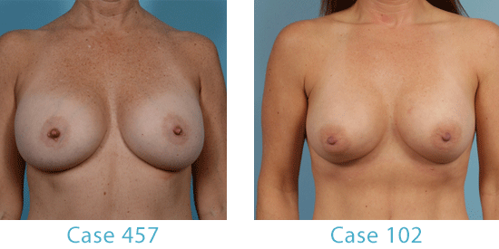 See before-and-after pictures of breast augmentation patients in Chicago. 