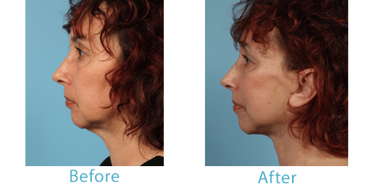 See more images from my facelift patients in Chicago. 