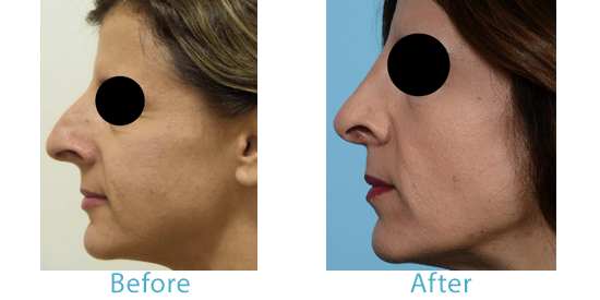 See before-and-after pictures from Dr. Mustoe's rhinoplasty patients in Chicago. 
