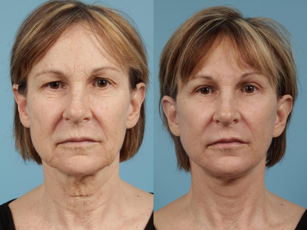 Front view of woman's face before and after brow lift and eyelid surgery.