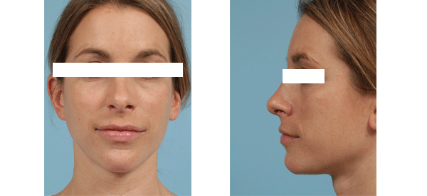 Female rhinoplasty results from Dr. Thomas Mustoe in Chicago.