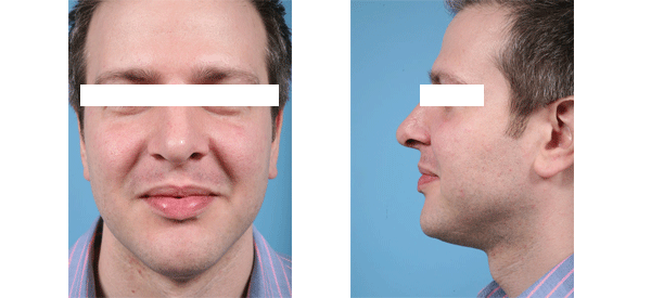 See male rhinoplasty patient photos from Dr. Thomas Mustoe in Chicago.