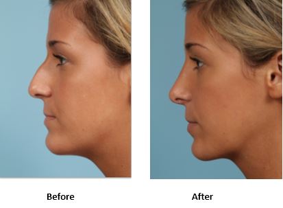 rhinoplasty before-and-after photos