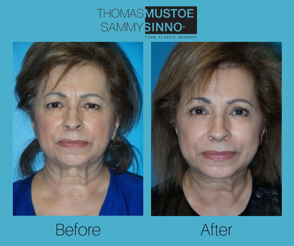 Facelift Before and After by Dr. Thomas Mustoe