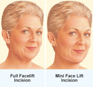 facelift diagram