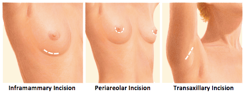 Breast Incision