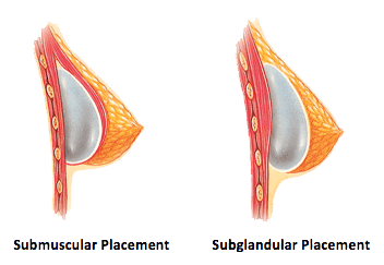 Implant Placement Diagram