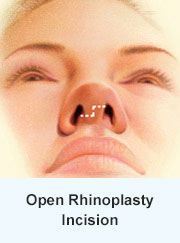 Rhinoplasty Incision