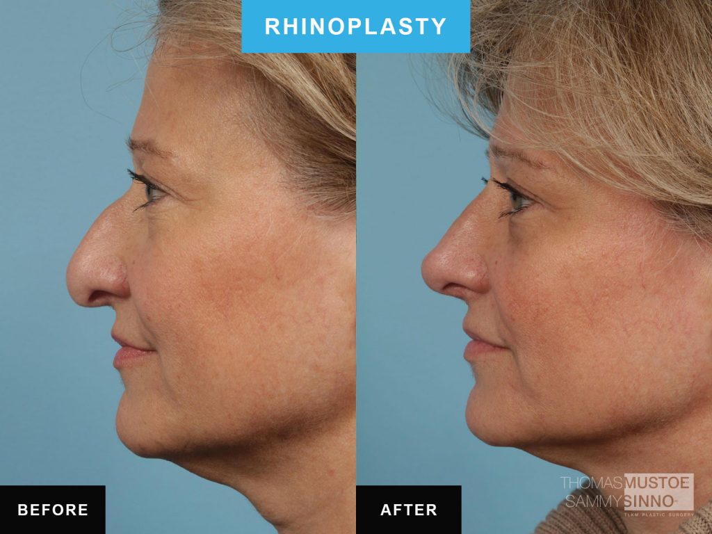 Chicago patient B&A - Rhinoplasty - Elevating the tip of the nose