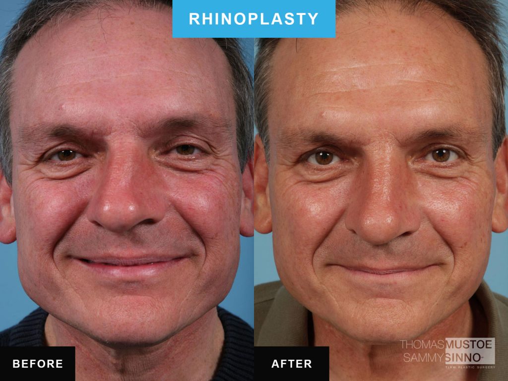 Rhinoplasty by Dr. Mustoe Case 45 Before & After View #3 | Chicago, IL | TLKM Plastic Surgery