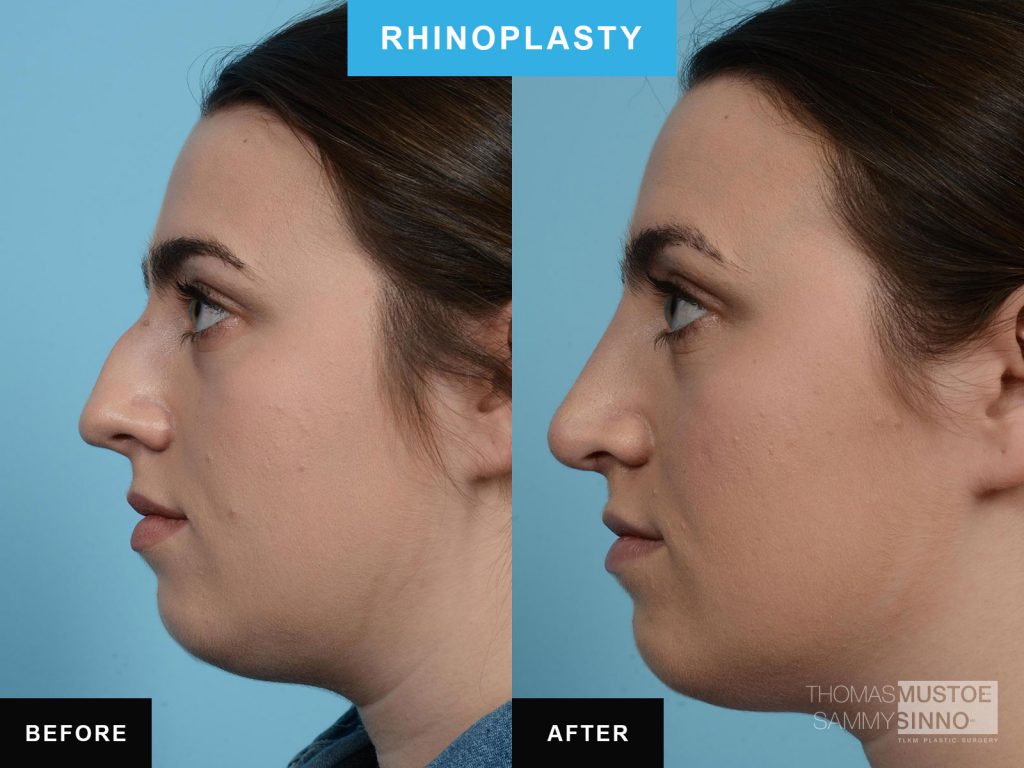 Rhinoplasty by Dr. Mustoe Case 577 Before & After View #2 | Chicago, IL | TLKM Plastic Surgery