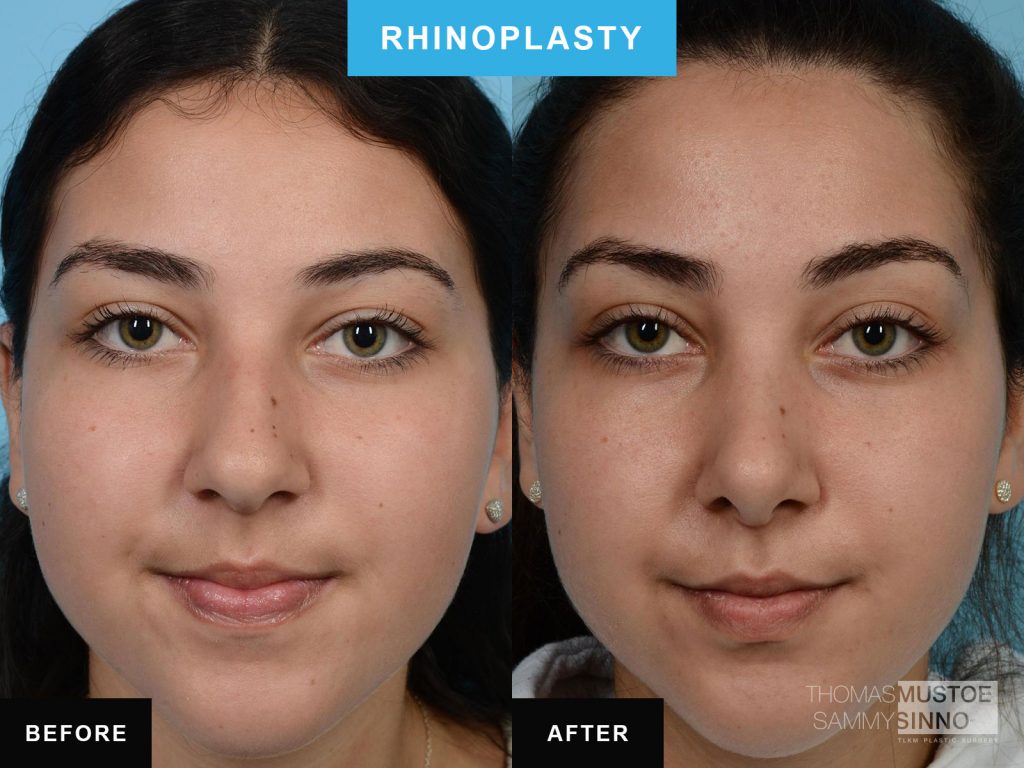 Rhinoplasty by Dr. Mustoe Case 586 Before & After View #1 | Chicago, IL | TLKM Plastic Surgery