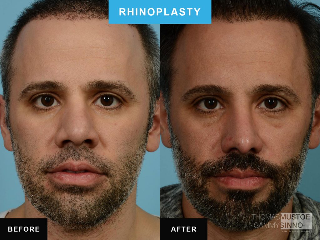 Chicago Rhinoplasty by Dr. Sammy Sinno - Narrowing the bridge - B&A