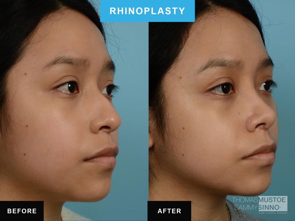 Chicago patient B&A - Rhinoplasty - Elevated tip of nose - Dr. Sinno