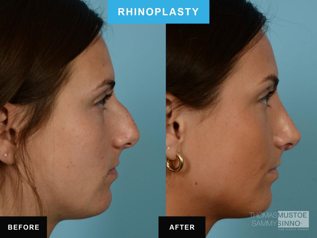 Chicago rhinoplasty B&A - Dorsal Hump - Dr. Sinno