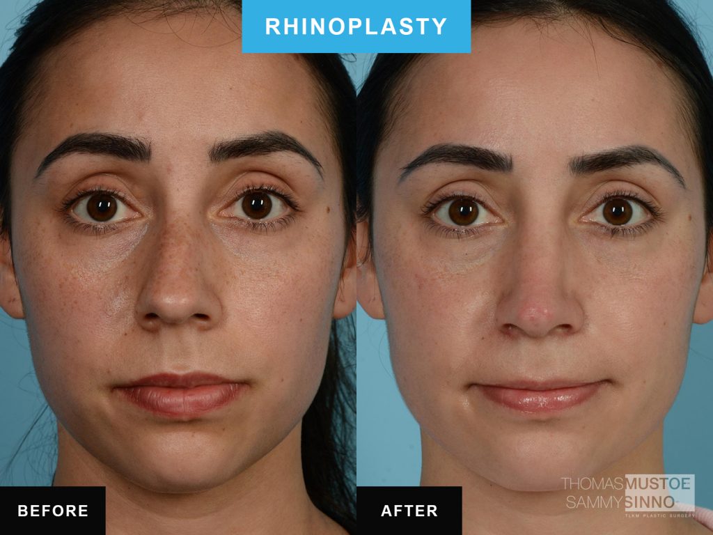 Rhinoplasty B&A - Narrowing bridge - Dr. Sammy Sinno - Chicago, IL