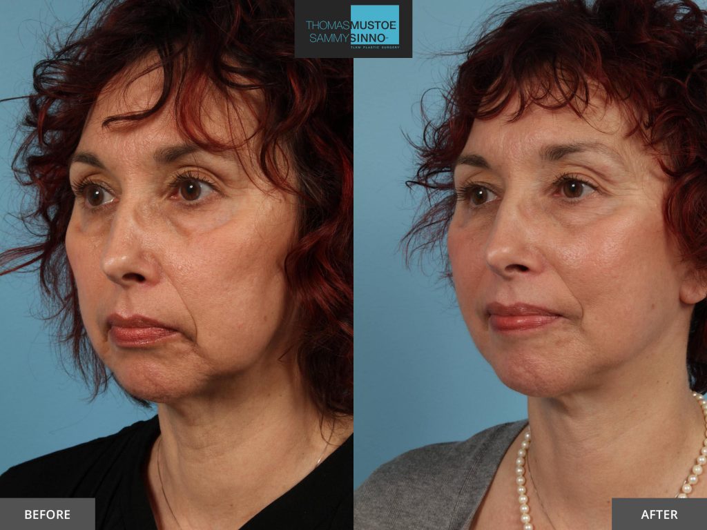 Chicago Facelift Before and After