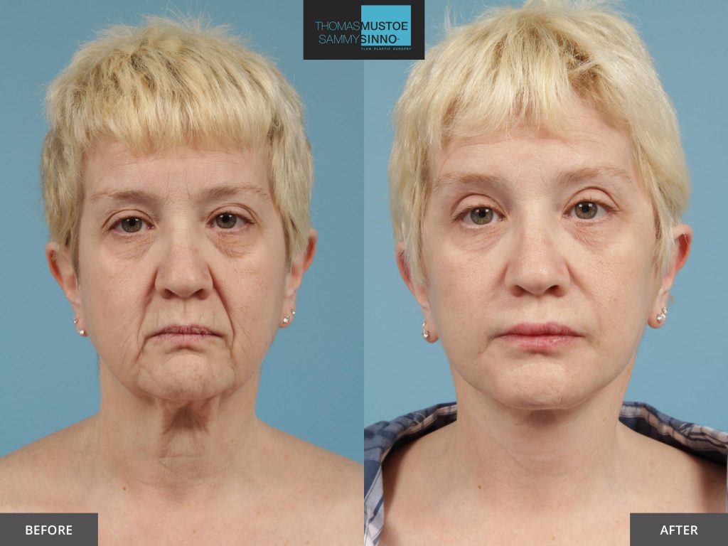 Chicago Facelift Before and After