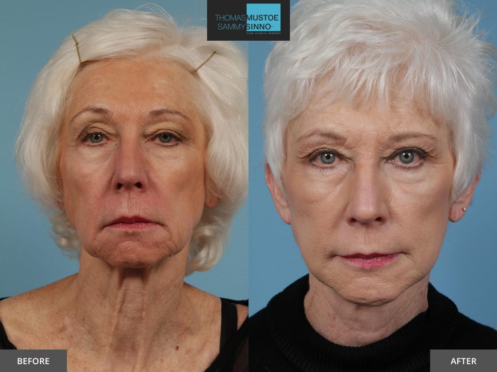 Chicago Facelift Before and After