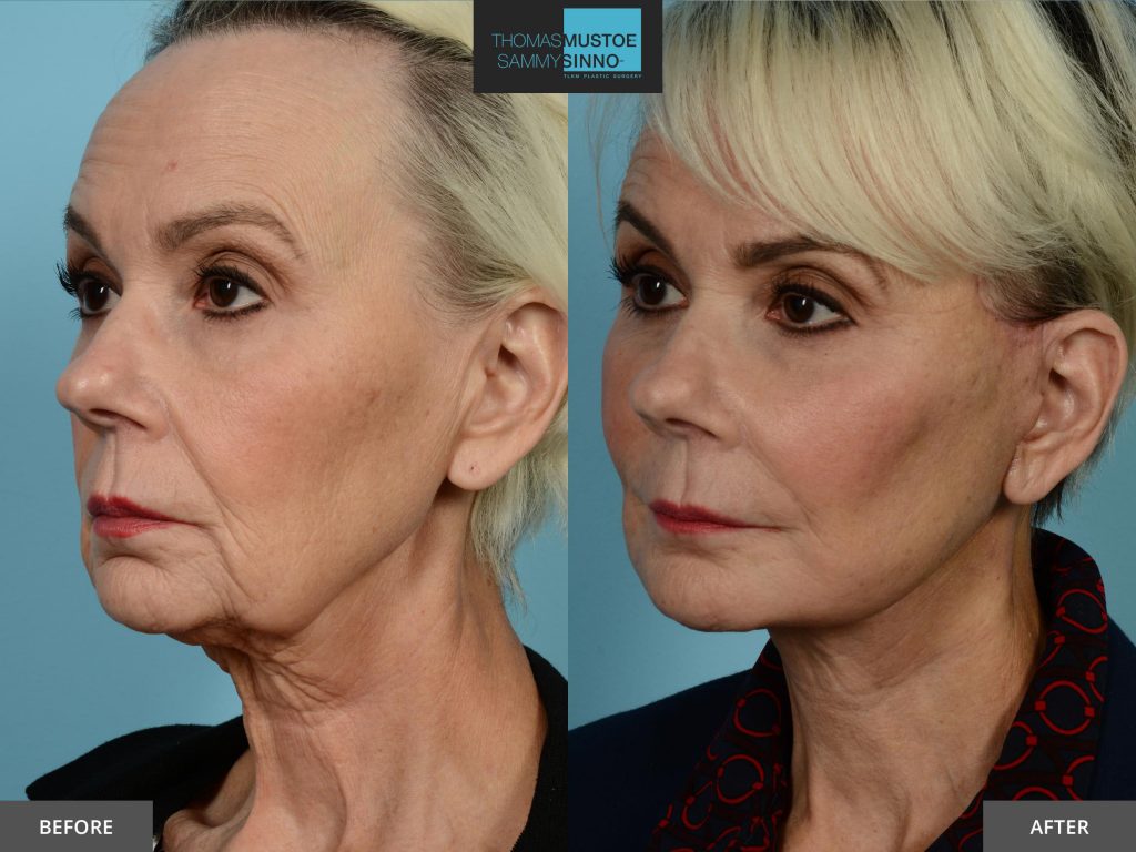 Chicago Facelift Before and After