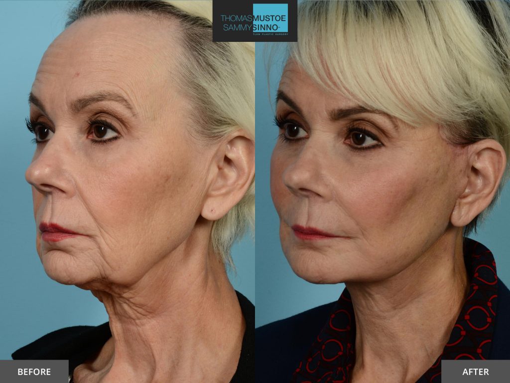 Chicago Facelift Before and After