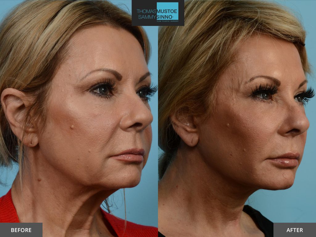 Chicago Facelift Before and After