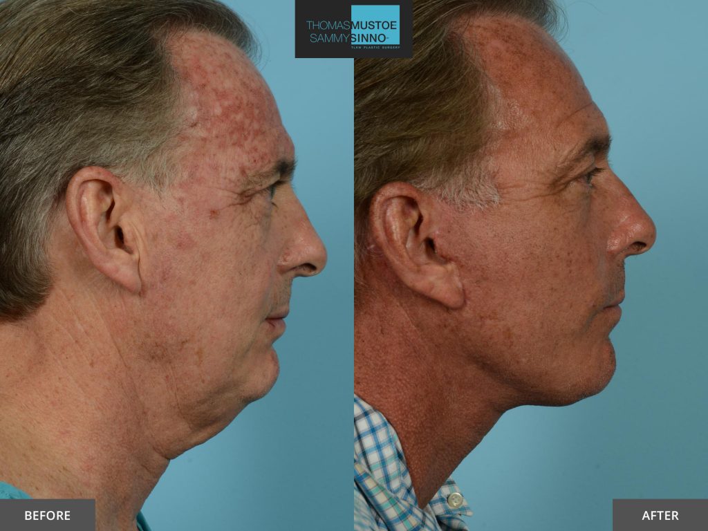 Chicago Facelift Before and After