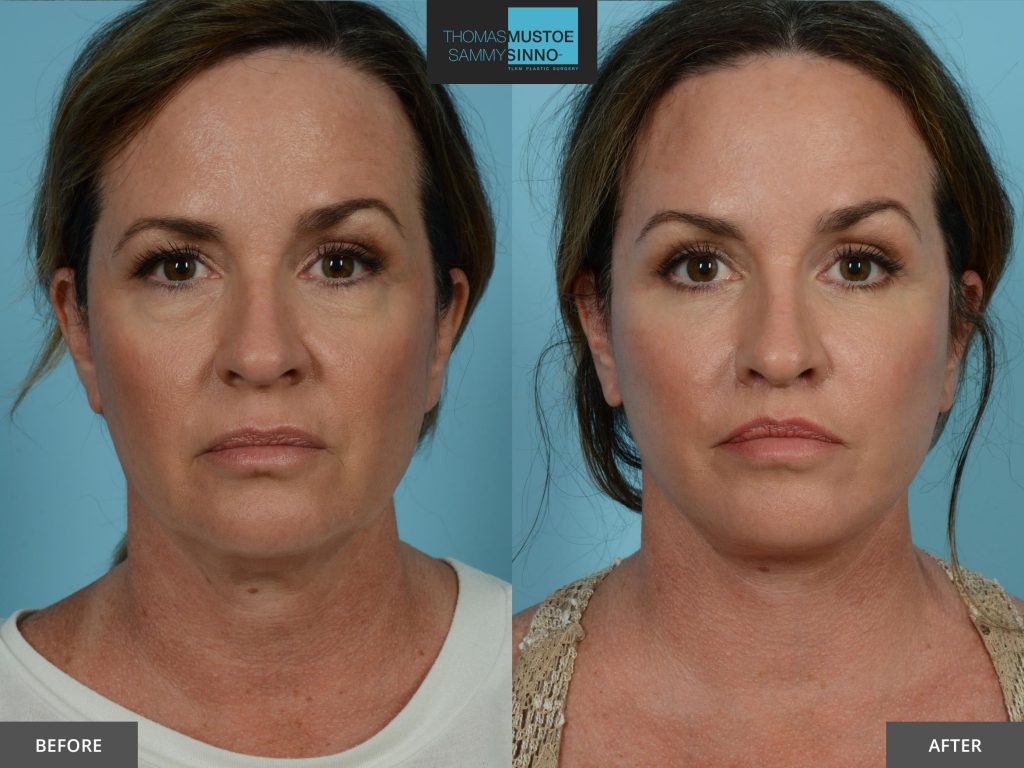 Chicago Facelift Before and After