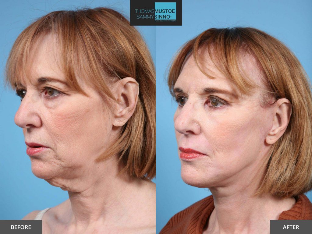 Chicago Facelift Before and After