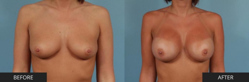 Breast Augmentation Results