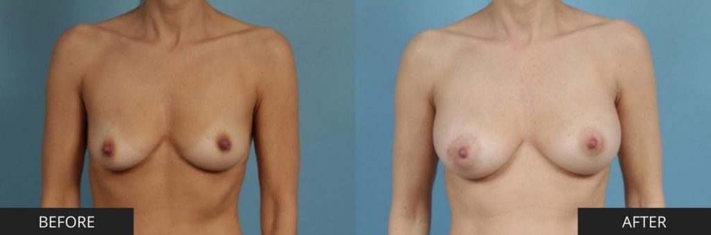 Breast Augmentation Results