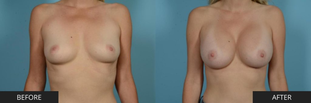 Breast augmentation by Dr. Sinno 