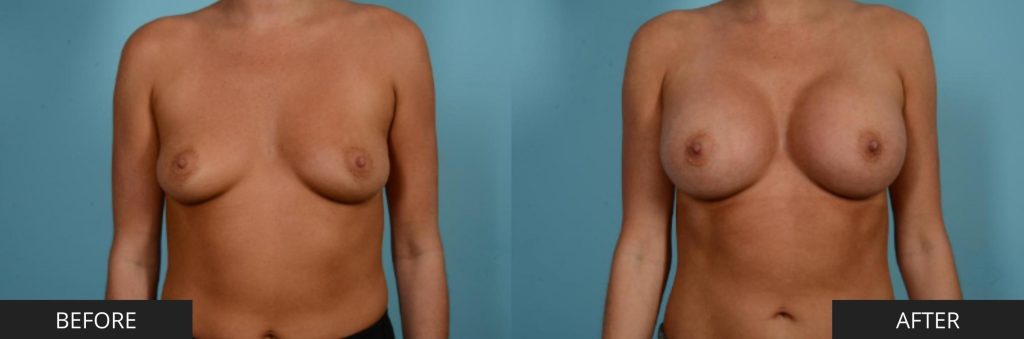 Breast Augmentation by Dr. Sammy Sinno