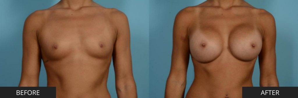 Breast Augmentation by Dr. Sammy Sinno