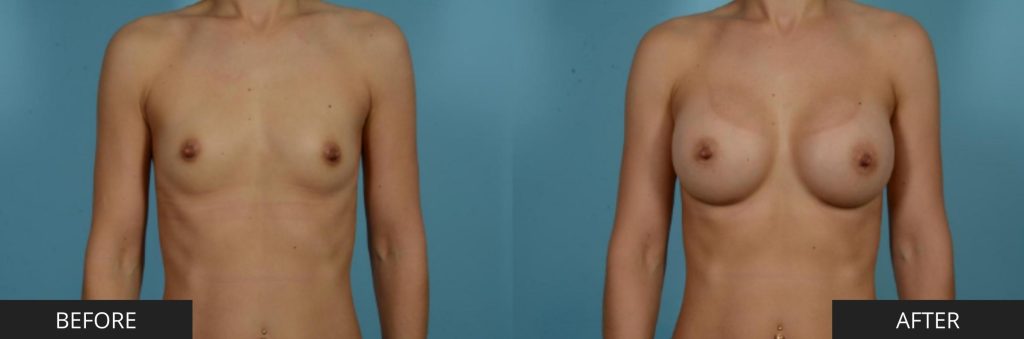 Breast Augmentation Results