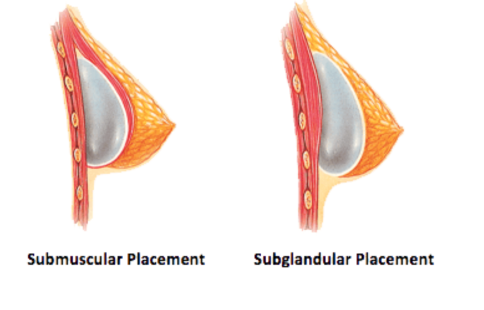 breast implant placement graphic