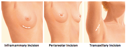 Types of Breast Implant graphic