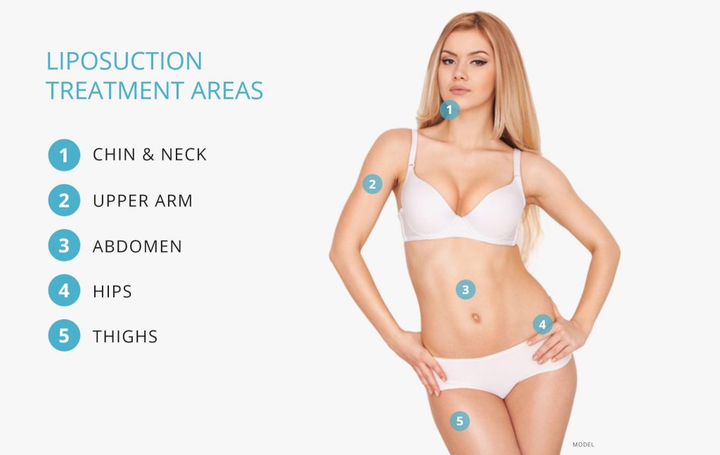Liposuction Treatment Areas Graphic