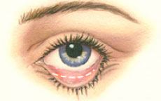diagram of lower eyelid surgery incision placement