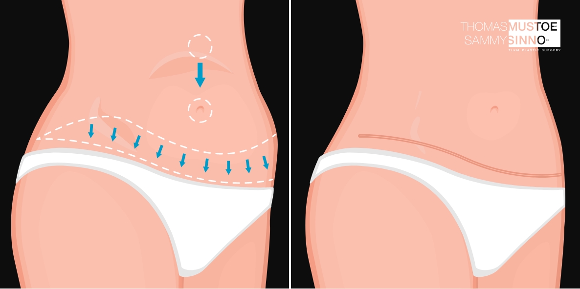 Tummy Tuck Incision Diagram
