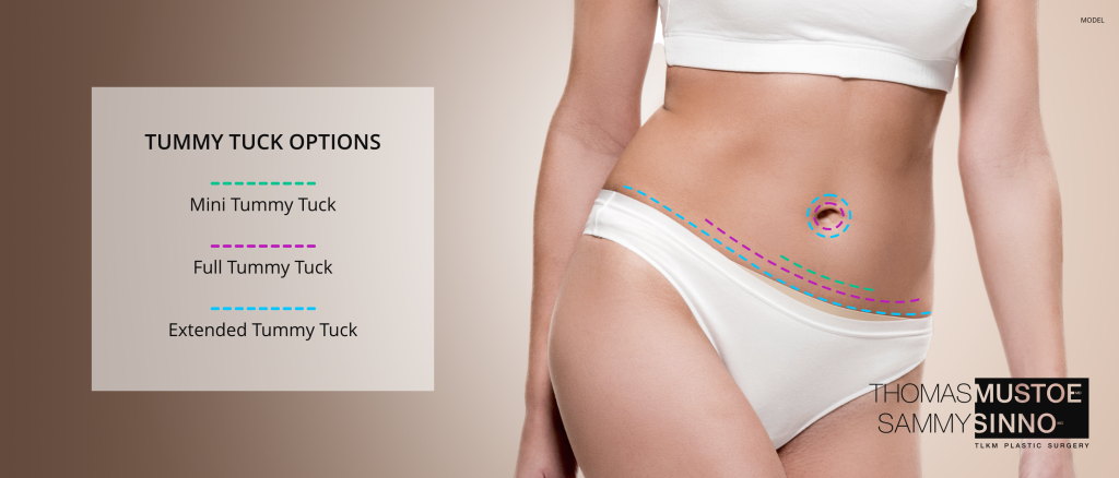 Tummy Tuck Options Graphic