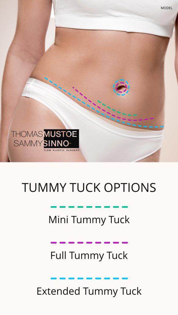 Tummy Tuck Options Graphic