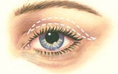 diagram of upper eyelid surgery area