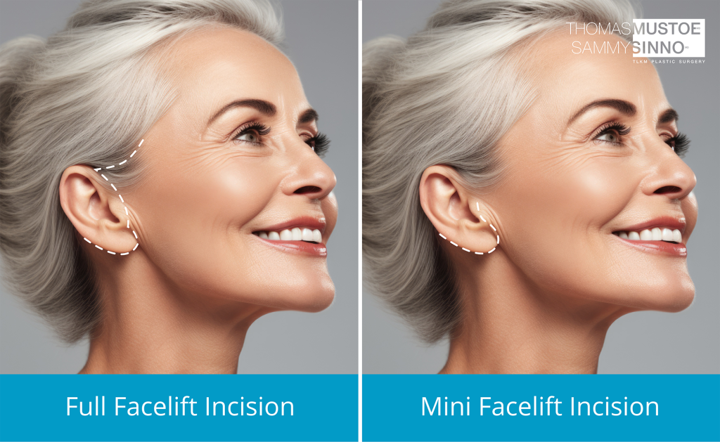 Full vs Mini Facelift diagram